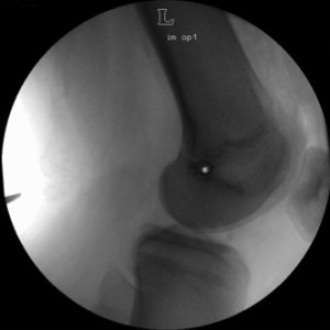 Röntgenbild einer Knieoperation